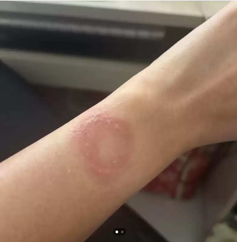 印度用户被苹果 Apple Watch 手表灼伤手腕,维权半年无果