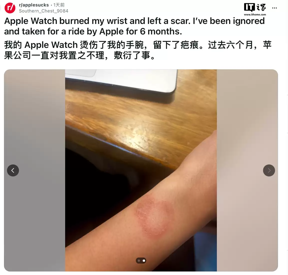 印度用户被苹果 Apple Watch 手表灼伤手腕，维权半年无果